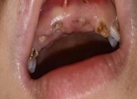 儿童乳牙蛀牙要不要处理？